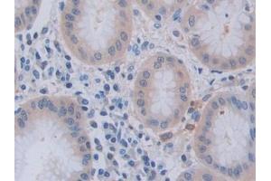 Detection of TNFSF9 in Human Stomach cancer Tissue using Polyclonal Antibody to Tumor Necrosis Factor Ligand Superfamily, Member 9 (TNFSF9)