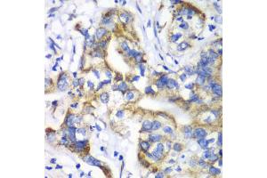 Immunohistochemistry of paraffin-embedded human liver cancer using RPL9 antibody (ABIN5973807) at dilution of 1/100 (40x lens). (RPL9 antibody)
