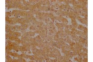Immunohistochemistry of paraffin-embedded human breast cancer using ABIN7174308 at dilution of 1:100 (USP3 antibody  (C-Term))