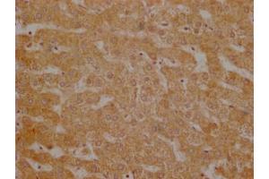 Immunohistochemistry of paraffin-embedded human breast cancer using ABIN7174308 at dilution of 1:100