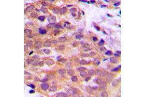 Immunohistochemical analysis of 14-3-3 theta/tau staining in human prostate cancer formalin fixed paraffin embedded tissue section. (14-3-3 theta antibody  (C-Term))