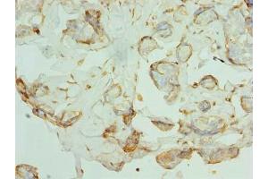 Immunohistochemistry of paraffin-embedded human breast cancer using ABIN7163824 at dilution of 1:100 (PKD1L2 antibody  (AA 1-306))