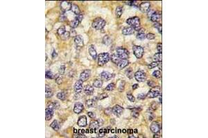 Formalin-fixed and paraffin-embedded human breast carcinoma tissue reacted with UCHL3 antibody (C-term), which was peroxidase-conjugated to the secondary antibody, followed by DAB staining.