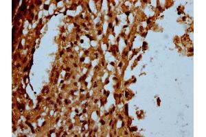 IHC image of ABIN7174180 diluted at 1:100 and staining in paraffin-embedded human melanoma performed on a Leica BondTM system. (C16orf57 antibody  (AA 1-90))