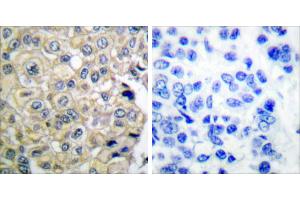 Peptide - +Immunohistochemical analysis of paraffin-embedded human breast carcinoma tissue using FGFR3 antibody. (FGFR3 antibody)