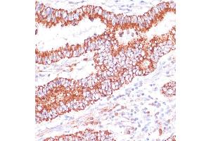 Immunohistochemistry of paraffin-embedded human colon carcinoma using ENTPD6 antibody (ABIN7266897) at dilution of 1:100 (40x lens). (ENTPD6 antibody  (AA 61-300))