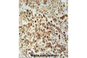VCX1 Antibody (N-term) immunohistochemistry analysis in formalin fixed and paraffin embedded human testis carcinoma followed by peroxidase conjugation of the secondary antibody and DAB staining. (VCX antibody  (N-Term))