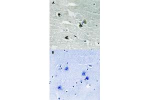 Immunohistochemical staining of human by MERTK/TYRO3 (phospho Y749/681) polyclonal antibody  without blocking peptide (A) or preincubated with blocking peptide (B) under 1:500-1000 dilution. (MERTK antibody  (pTyr681, pTyr749))
