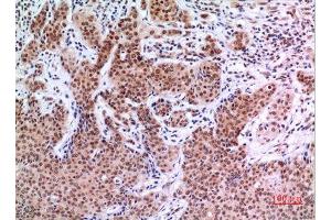 Immunohistochemistry (IHC) analysis of paraffin-embedded Human Mammary Cancer, antibody was diluted at 1:100. (EPAS1 antibody  (Ser343))