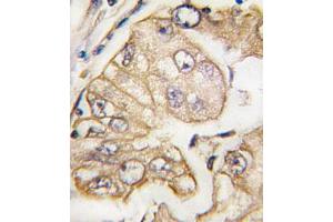 Immunohistochemical staining of formalin-fixed and paraffin-embedded human lung carcinoma tissue reacted with FLT4 monoclonal antibody  at 1:10-1:50 dilution. (FLT4 antibody)