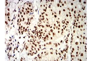Immunohistochemical analysis of paraffin-embedded bladder cancer tissues using UHRF1 mouse mAb with DAB staining. (UHRF1 antibody  (AA 616-755))