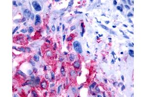 Anti-NPBWR2 / GPR8 antibody IHC of human Pancreas, Carcinoma. (NPBWR2 antibody  (N-Term))