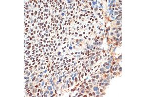 Immunohistochemistry of paraffin-embedded human esophageal cancer using KDM3B Rabbit pAb (ABIN1680577, ABIN3015976, ABIN3015977 and ABIN6219483) at dilution of 1:100 (40x lens). (KDM3B antibody  (AA 1059-1283))