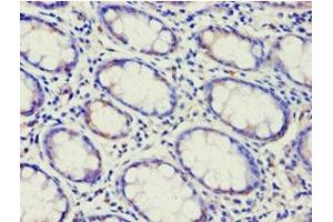 Immunohistochemistry of paraffin-embedded human colon cancer using ABIN7144925 at dilution of 1:100 (ABCF2 antibody  (AA 1-250))