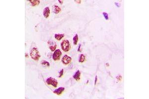 Immunohistochemical analysis of PIAS3 staining in human lung cancer formalin fixed paraffin embedded tissue section. (PIAS3 antibody  (N-Term))