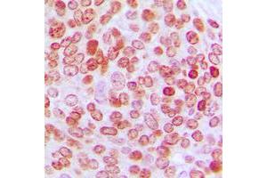 Immunohistochemical analysis of PE2 staining in human ovarian cancer formalin fixed paraffin embedded tissue section. (ERF antibody  (C-Term))