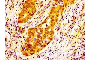 IHC image of ABIN7168283 diluted at 1:300 and staining in paraffin-embedded human pancreatic cancer performed on a Leica BondTM system. (NAT1 antibody  (AA 909-1025))