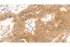 Immunohistochemistry of paraffin-embedded Human breast cancer tissue using TMEFF2 Polyclonal Antibody at dilution 1:35 (TMEFF2 antibody)