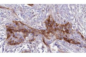 ABIN6274910 at 1/100 staining Human urothelial cancer tissue by IHC-P. (B4GALT1 antibody  (C-Term))