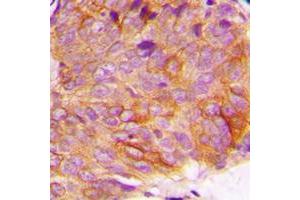 Immunohistochemical analysis of GSK3 alpha (pS21) staining in human breast cancer formalin fixed paraffin embedded tissue section. (GSK3 alpha antibody  (N-Term, pSer21))