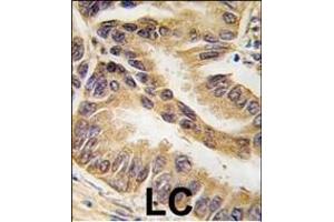 Formalin-fixed and paraffin-embedded human lung carcinoma tissue reacted with RAF1-p, which was peroxidase-conjugated to the secondary antibody, followed by DAB staining. (RAF1 antibody  (AA 599-628))