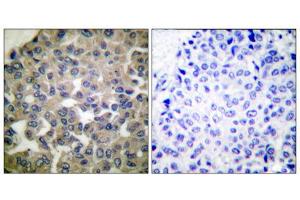 Immunohistochemical analysis of paraffin-embedded human breast carcinoma tissue using PLCG1 (epitope around residue 771) antibody (ABIN5976161). (Phospholipase C gamma 1 antibody  (Tyr771))
