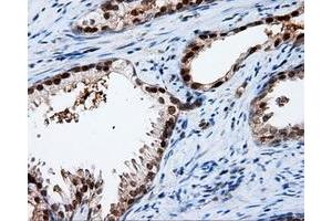Immunohistochemical staining of paraffin-embedded Adenocarcinoma of ovary tissue using anti-APP mouse monoclonal antibody. (APP antibody)