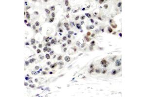 Immunohistochemistry of paraffin-embedded human breast carcinoma using Phospho-ESR1-S106 antibody (ABIN2988004). (Estrogen Receptor alpha antibody  (pSer106))