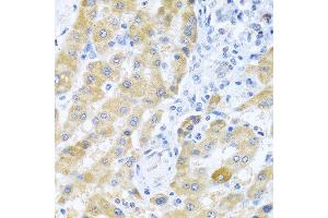 Immunohistochemistry of paraffin-embedded human liver cancer using Gm13125 antibody.