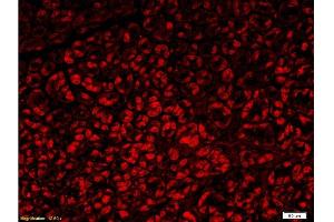 Formalin-fixed and paraffin embedded human gastric carcinoma with Anti-Fascin1 Polyclonal Antibody, Unconjugated  at 1:300, followed by conjugation to the secondary antibody Goat Anti-Rabbit IgG, PE conjugated -PE)used at 1:200 dilution for 40 minutes at 37°C. (Fascin antibody  (AA 11-110))