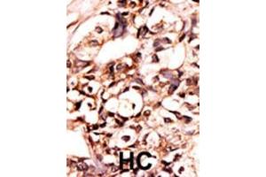 Formalin-fixed and paraffin-embedded human cancer tissue reacted with the primary antibody, which was peroxidase-conjugated to the secondary antibody, followed by AEC staining. (DAXX antibody  (pSer213))