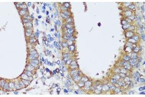 Immunohistochemistry of paraffin-embedded Human uterine cancer using ERK1 / ERK2 Polyclonal Antibody at dilution of 1:200 (40x lens). (ERK1/2 antibody)