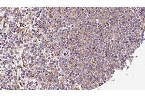 ABIN6273217 at 1/100 staining Human lymph cancer tissue by IHC-P. (CRLS1 antibody  (Internal Region))