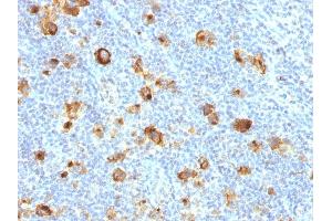 Formalin-fixed, paraffin-embedded human Hodgkin's Lymphoma stained with CD15 Rabbit Recombinant Monoclonal Antibody (FUT4/1478R). (Recombinant CD15 antibody)