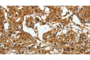 Immunohistochemistry of paraffin-embedded Human lung cancer tissue using AKAP12 Polyclonal Antibody at dilution 1:40