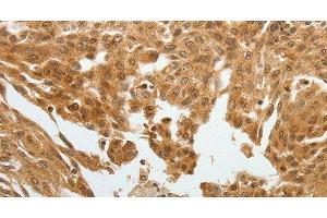 Immunohistochemistry of paraffin-embedded Human cervical cancer tissue using RETNLB Polyclonal Antibody at dilution 1:40