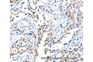 Immunohistochemistry of Human esophagus cancer using AOX1 Polyclonal Antibody at dilution of 1:65 (AOX1 antibody)