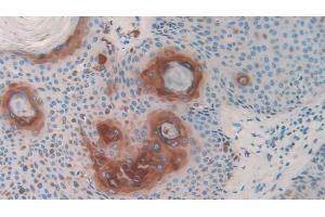 Detection of INV in Human Skin Tissue using Polyclonal Antibody to Involucrin (INV) (Involucrin antibody  (AA 36-152))