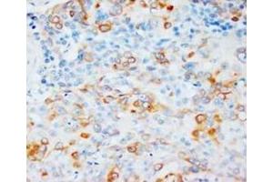 Immunohistochemical analysis of paraffin embedded ESCC sections, staining VEGF in cytoplams, DAB chromogenic reaction