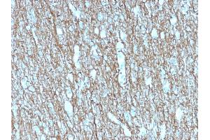 Formalin-fixed, paraffin-embedded human Brain stained with Neurofilament Mouse Recombinant Monoclonal Antibody (rNF421). (Recombinant NEFH antibody)