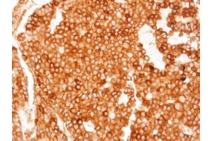 IHC-P Image Immunohistochemical analysis of paraffin-embedded HUH-7 xenograft, using TGR5, antibody at 1:100 dilution. (GPBAR1 antibody  (C-Term))