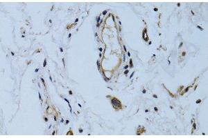 Immunohistochemistry of paraffin-embedded Human colon carcinoma using MCAM Polyclonal Antibody at dilution of 1:100 (40x lens).