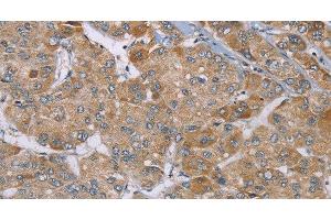 Immunohistochemistry of paraffin-embedded Human liver cancer using ACTN2 Polyclonal Antibody at dilution of 1:30 (ACTN2 antibody)