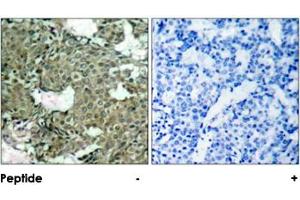 Immunohistochemical analysis of paraffin-embedded human breast carcinoma tissue using MAP2K1 (phospho S221) polyclonal antibody . (MEK1 antibody  (pSer221))