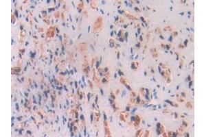 Detection of BCHE in Human Prostate cancer Tissue using Polyclonal Antibody to Butyrylcholinesterase (BCHE) (Butyrylcholinesterase antibody  (AA 29-150))