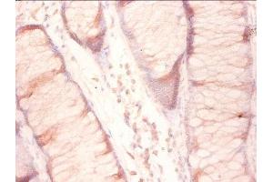 Immunohistochemistry of paraffin-embedded human colon cancer using ABIN7142788 at diluton of 1:50 (RPL27 antibody  (AA 2-136))