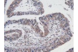 Detection of VEGF121 in Human Liver Cancer Tissue using Monoclonal Antibody to Vascular Endothelial Growth Factor 121 (VEGF121) (VEGF121 antibody  (AA 28-147))