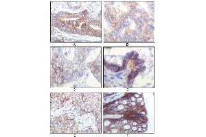 Immunohistochemical analysis of paraffin-embedded human gastric adenocarcinoma(A), colon adenocarcinoma(B), endometrial carcinoma(uterus)(C), ovary adenocarcinoma(D), lung squamous cell carcinoma(E), stomach epithelium mucosae(F), showing membrane localization using IGF1R antibody with DAB staining. (IGF1R antibody)