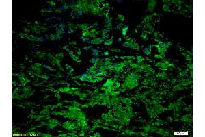 Formalin-fixed and paraffin embedded human gastric carcinoma labeled with Anti CCR7/CD197 Polyclonal Antibody, Unconjugated (ABIN674724) at 1:200 followed by conjugation to the secondary antibody Goat Anti-Rabbit IgG, Cy5 conjugated used at 1:200 dilution (CCR7 antibody  (AA 25-59))