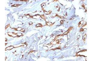 Formalin-fixed, paraffin-embedded human Angiosarcoma stained with CD34 Recombinant Rabbit Monoclonal Antibody (HPCA1/2598R). (Recombinant CD34 antibody)